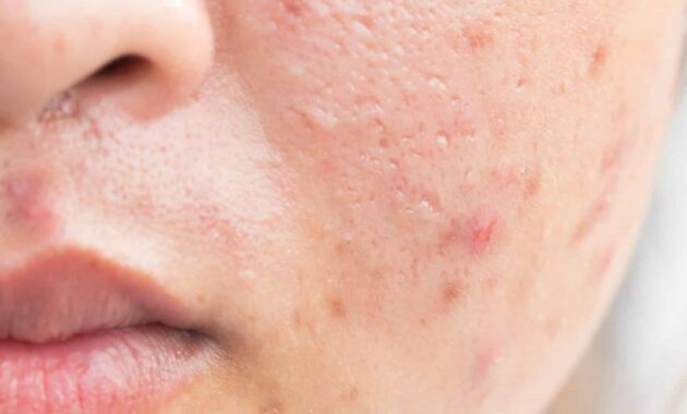 4 How to Whiten Acne Scars on the Face Quickly and Easily