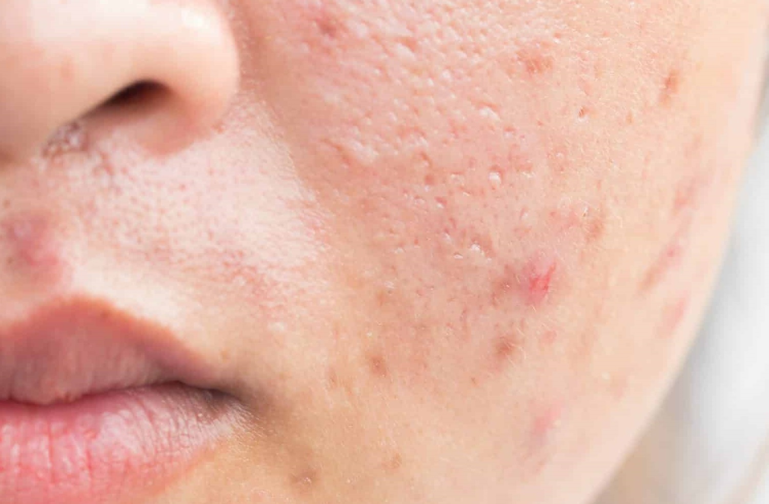 4 How to Whiten Acne Scars on the Face Quickly and Easily